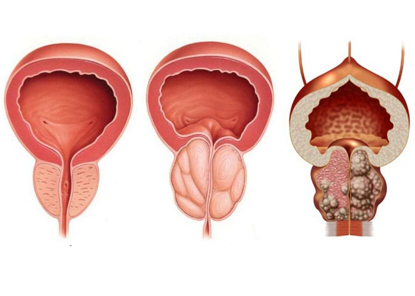 Etapy zapalenia prostaty i potrzeba pełnego korzystania z prostawitów