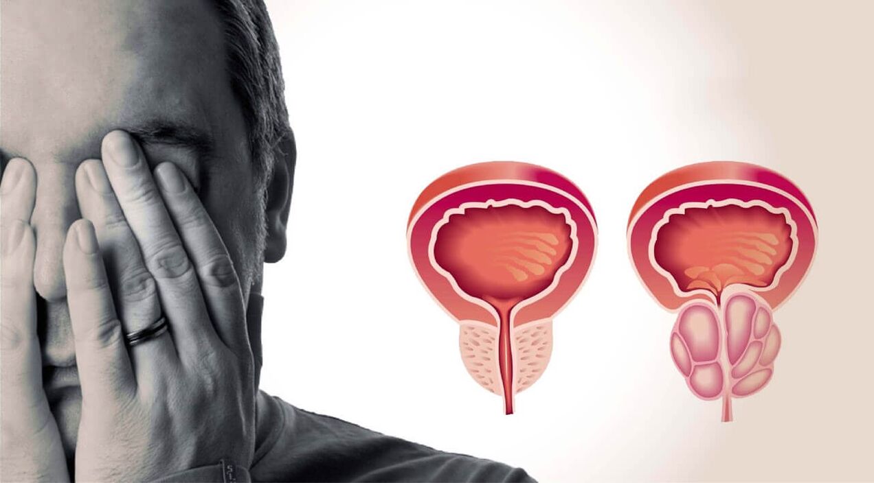 Zdrowa i obolała prostata u mężczyzn